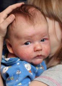 Baby with eczema on face, personal photo