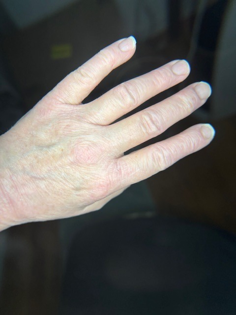 Kim's hand after, clear skin, shared with permission
