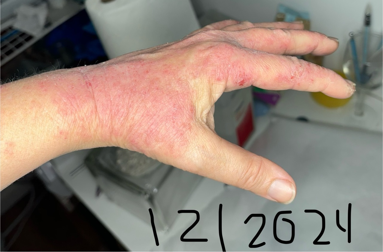 Kim's hand before, red and inflamed, shared with permission