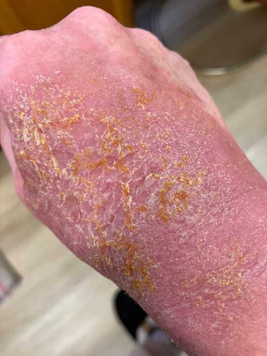 Serena's hand and arm before, red with yellow crusting from infection, shared with permission