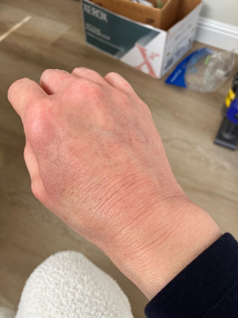 Serena's right hand after, calmer skin, shared with permission